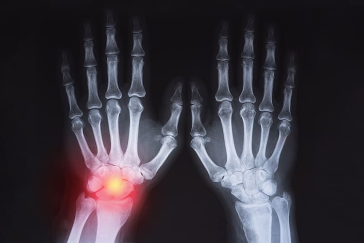 Rheumatoid arthritis , Gouty arthritis ( Film x-ray hand of child with arthritis at multiple joint )